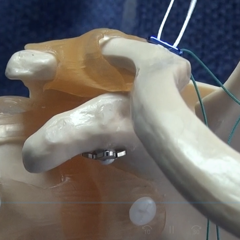 黃金WU | 小切口可調(diào)節(jié)帶袢鈦板固定肩鎖脫位